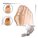 Orthopaedic Bunion Corrector
