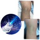 Blue light skin therapy pen