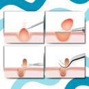 Ultra Precision Pointed Tweezers